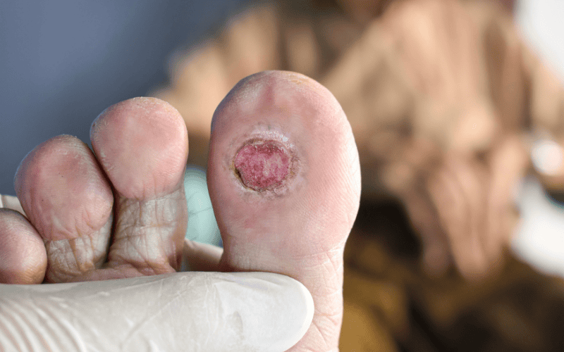 2.10 Biến chứng bàn chân đái tháo đường_ Nhận biết sớm để tránh cắt cụt chi.png