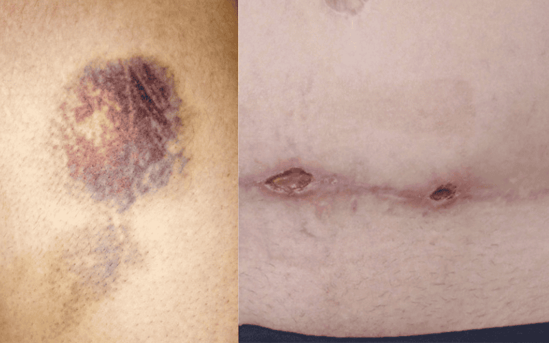 Phẫu thuật hút mỡ có thể gây nên những biến chứng nguy hiểm