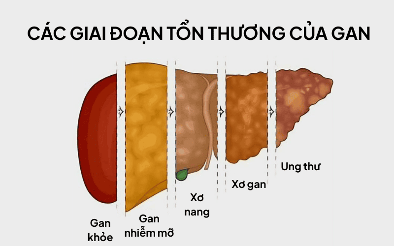 Các giai đoạn tổn thương gan.png