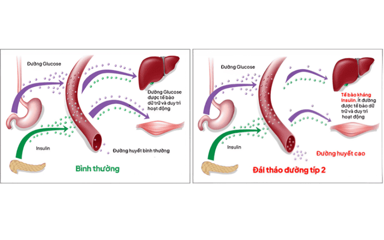 Tiểu đường típ 2.png