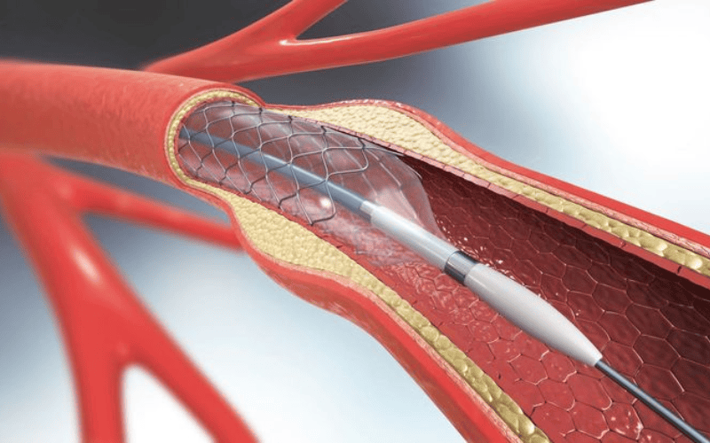 dat-stent.png