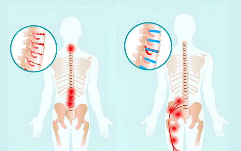 đau thần kinh xương khớp.png