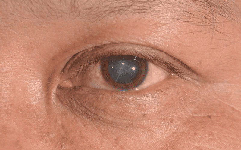 đục thủy tinh thể.png