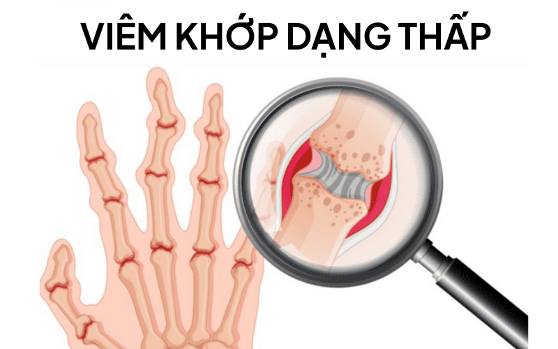 viêm khớp dạng thấp.png