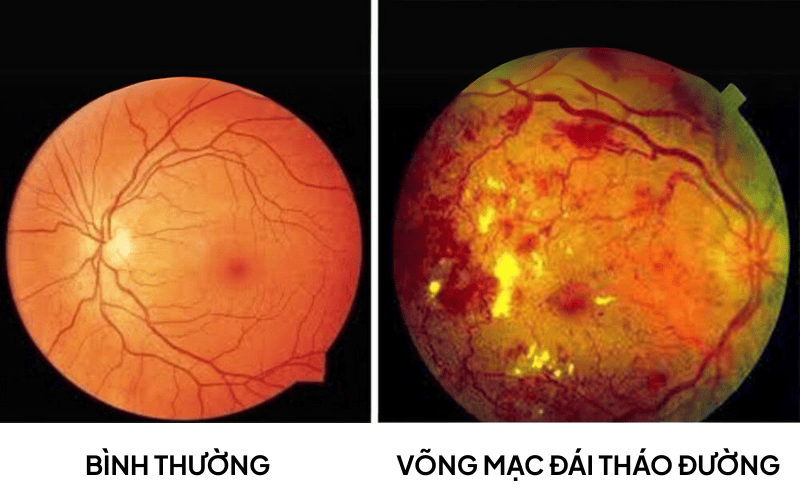 võng mạc đái tháo đường.png